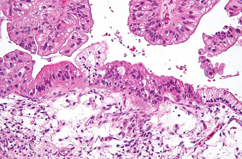  Los tres tipos de cáncer de ovario, explicados